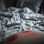 Flick International Close-up of a hotel bed with black bedbugs and a swollen bug bite on a pillow